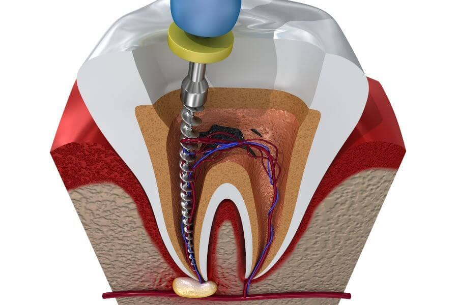 Dentist in Weston Root canal treatment process. 3D illustration